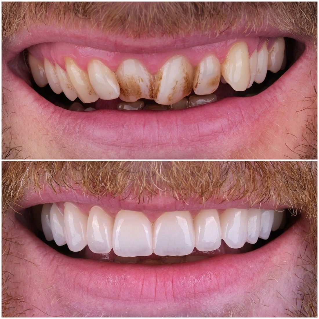 Before and after veneers