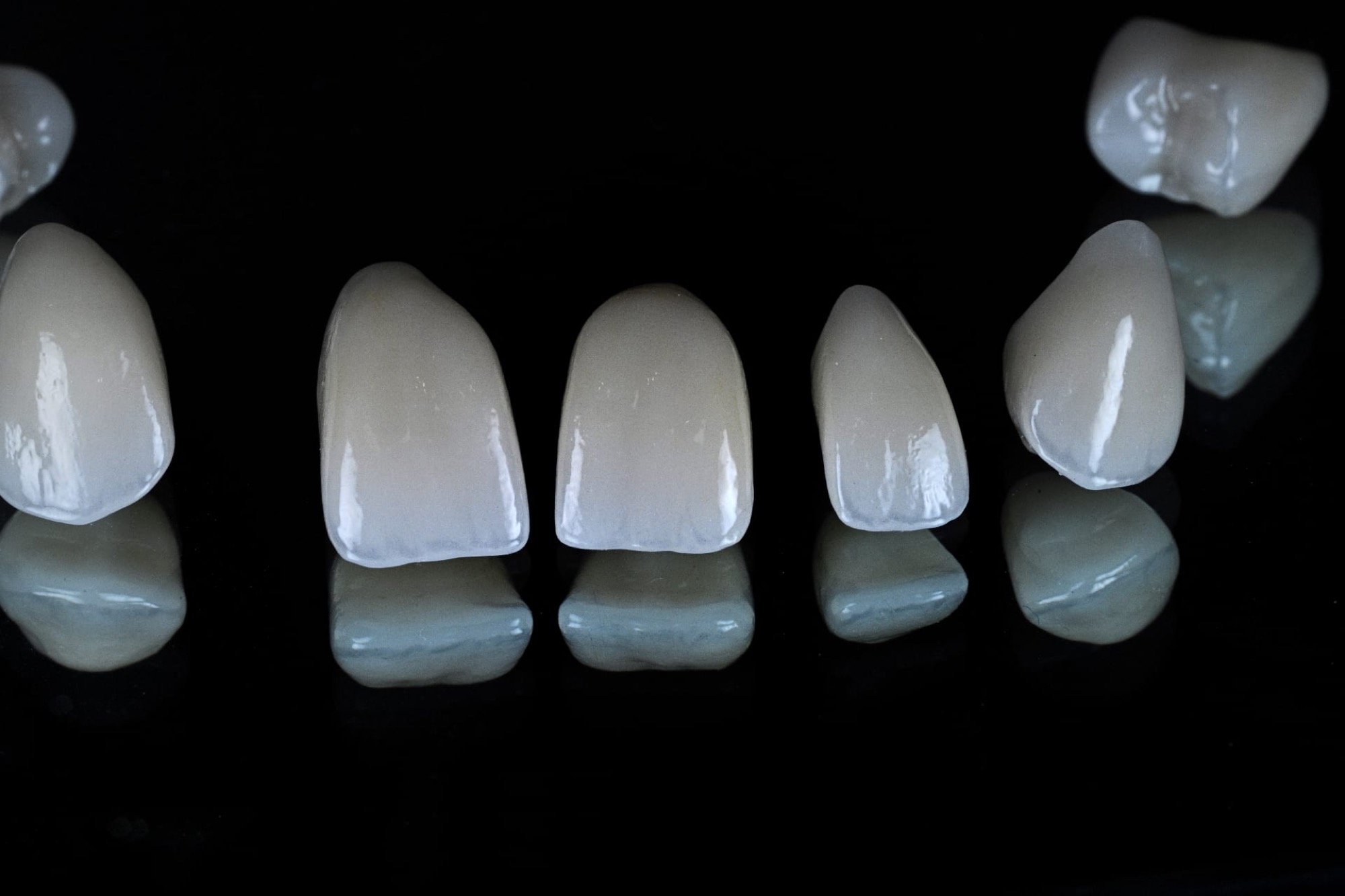 Hand-built porcelain veneers
