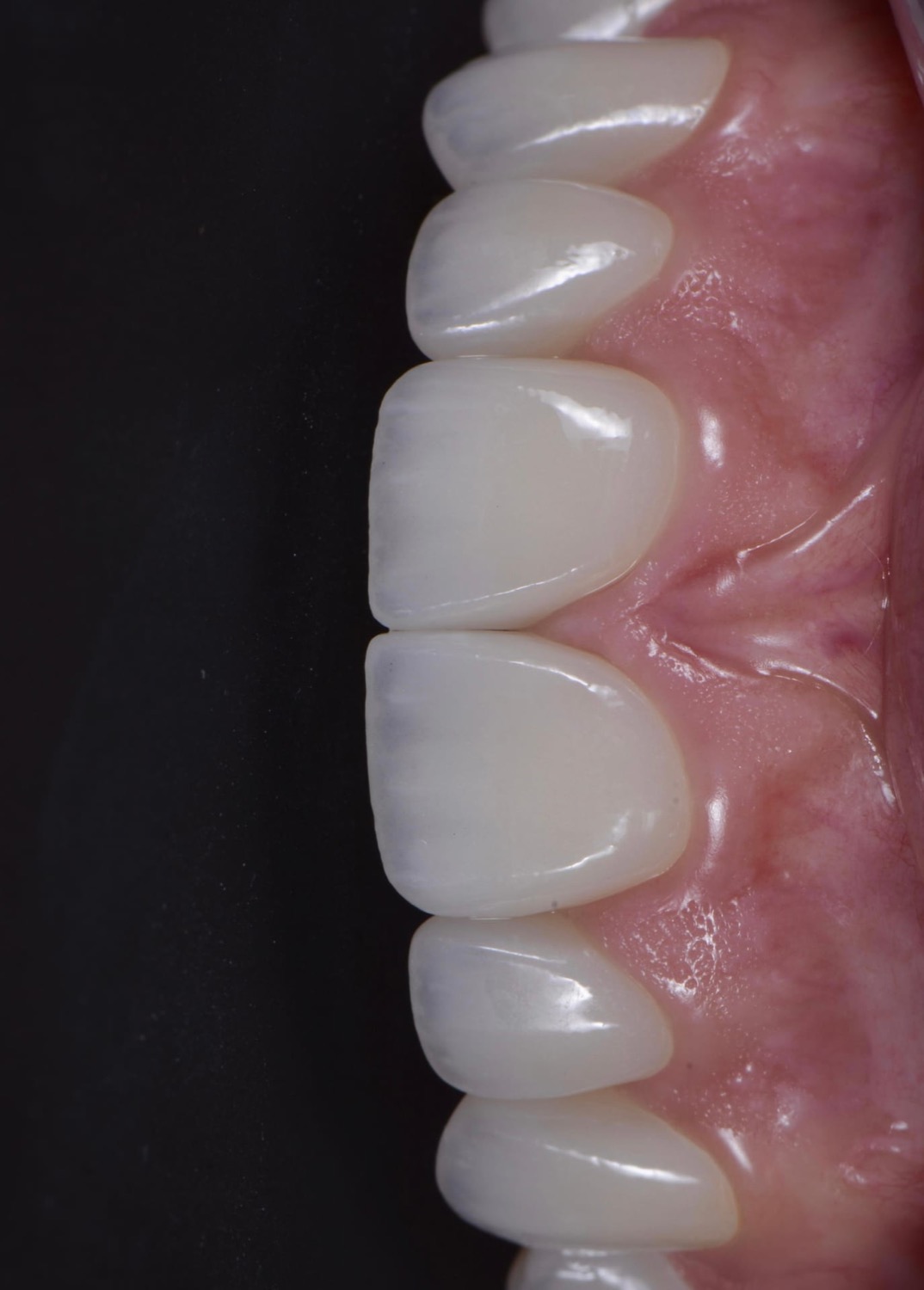 ACE DNTL porcelain veneers